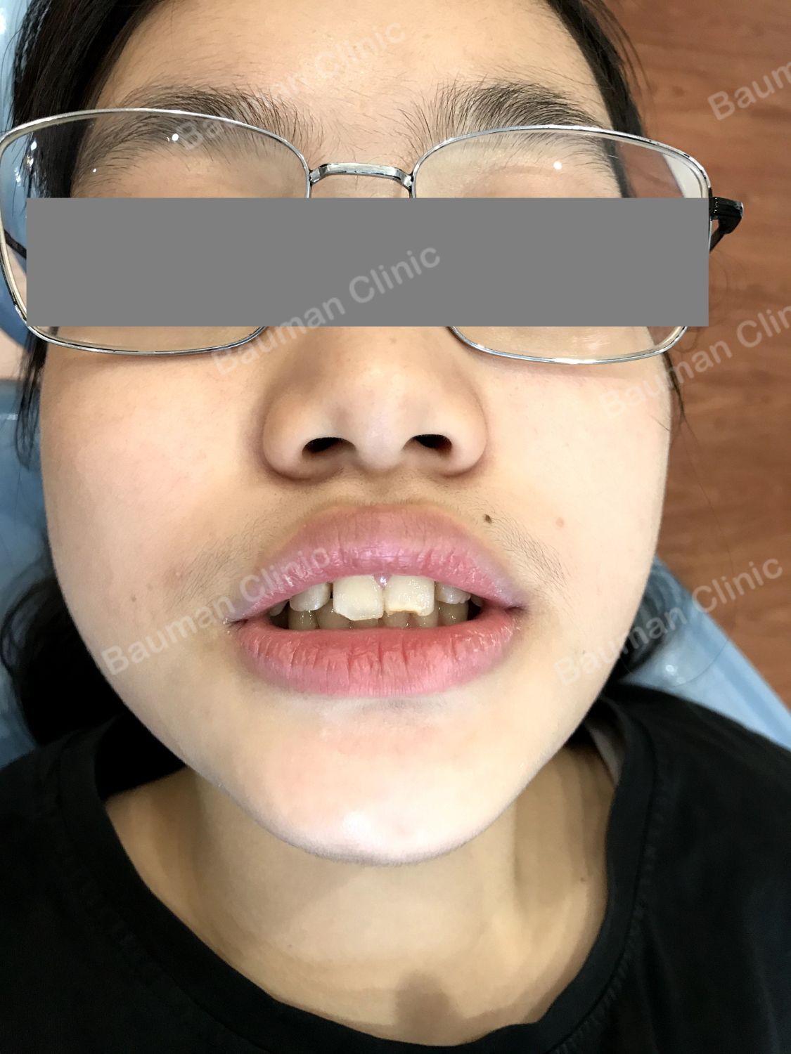 Ca niềng răng số 5016 - Nha khoa Bauman Clinic