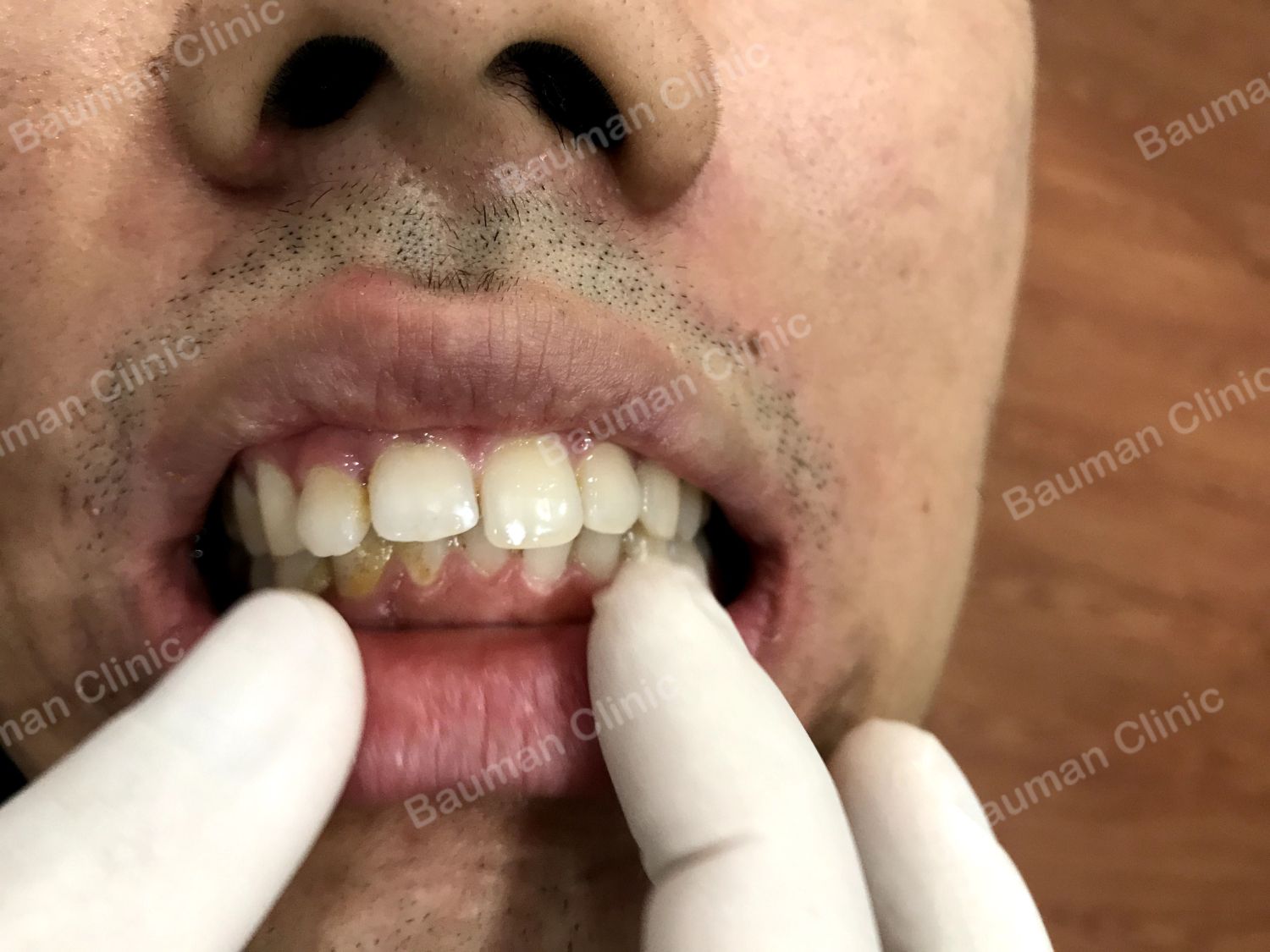 Ca niềng răng số 5017 - Nha khoa Bauman Clinic