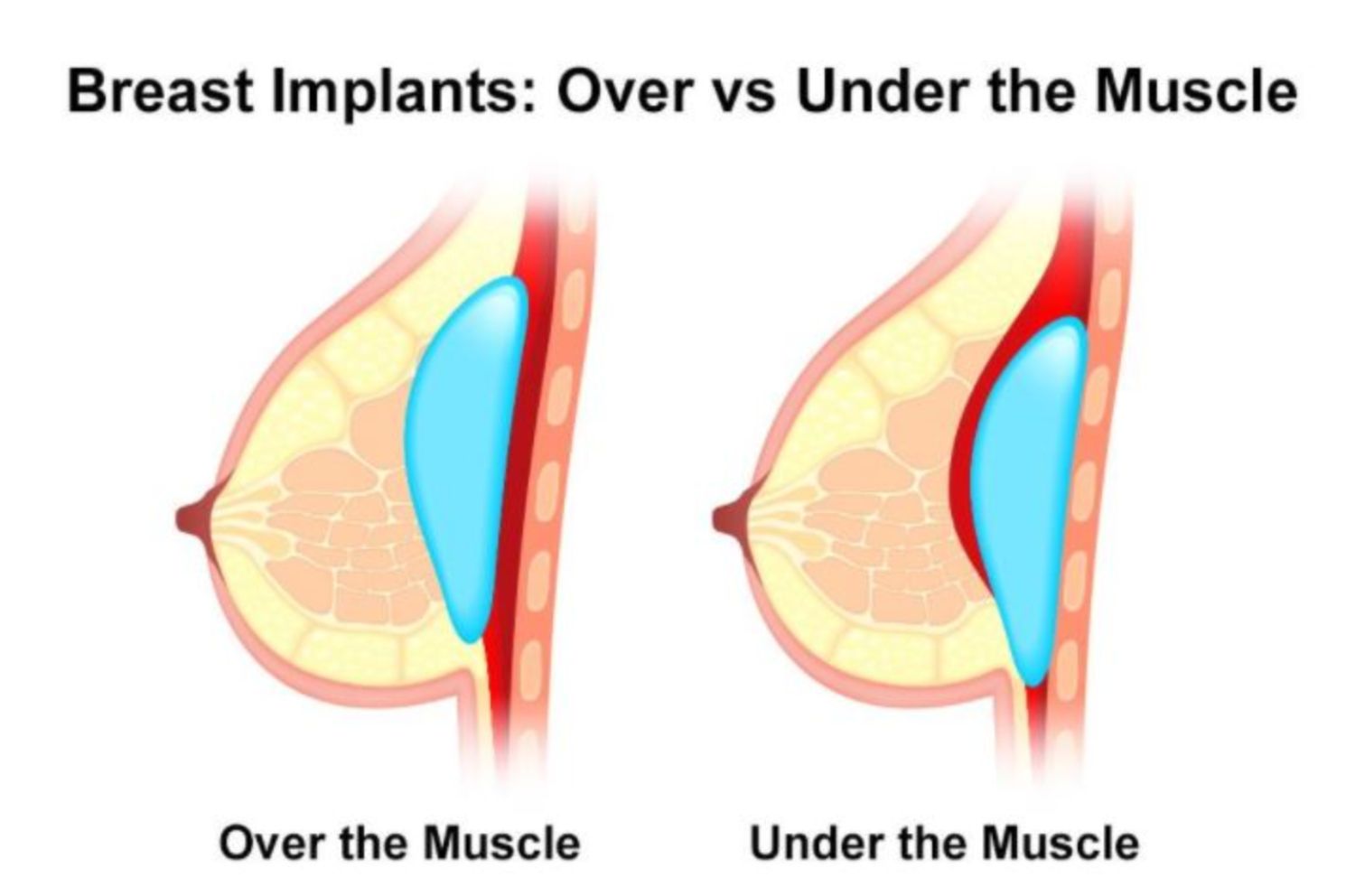So sánh vị trí đặt túi độn: dưới cơ ngực và trên cơ ngực - Thẩm mỹ Bauman Clinic