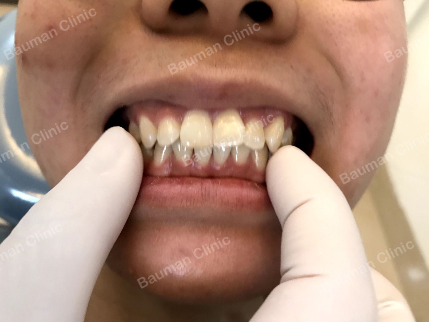 Ca niềng răng số 5010 - Nha khoa Bauman Clinic