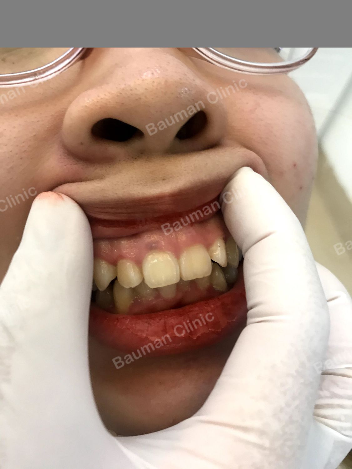 Ca niềng răng số 5014 - Nha khoa Bauman Clinic
