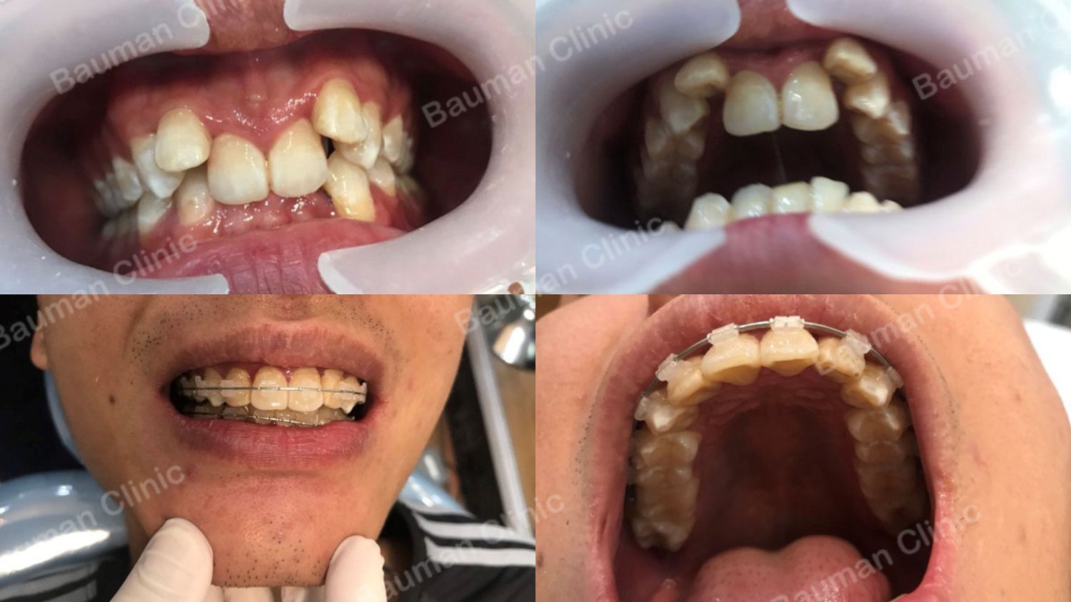 Ca niềng răng số 5084 - Nha khoa Bauman Clinic