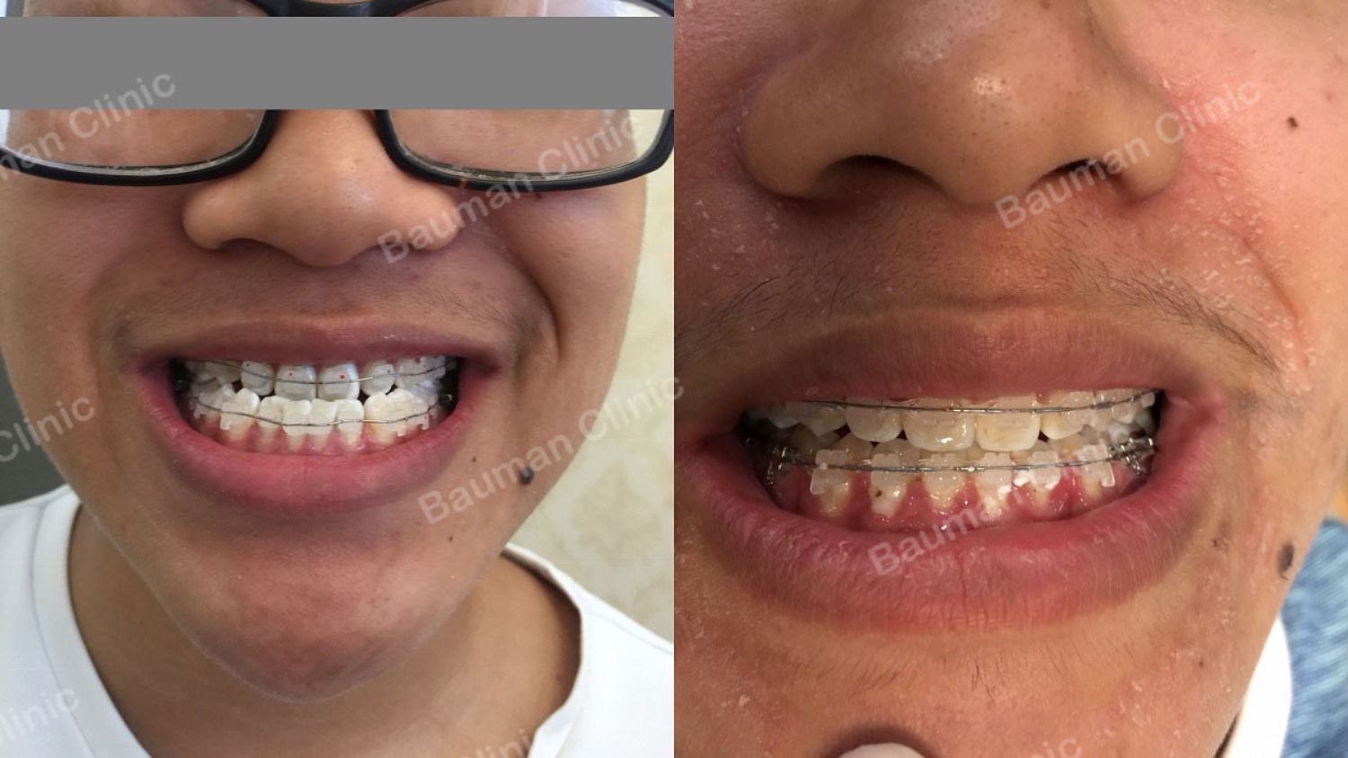 Ca niềng răng số 5079 - Nha khoa Bauman Clinic