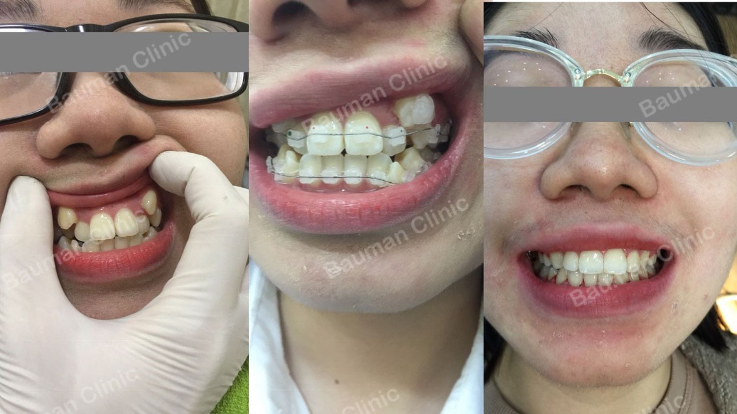 Ca niềng răng số 5080 - Nha khoa Bauman Clinic