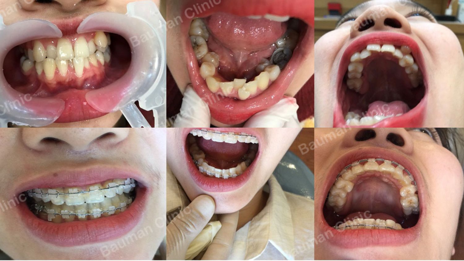 Ca niềng răng số 5081 - Nha khoa Bauman Clinic