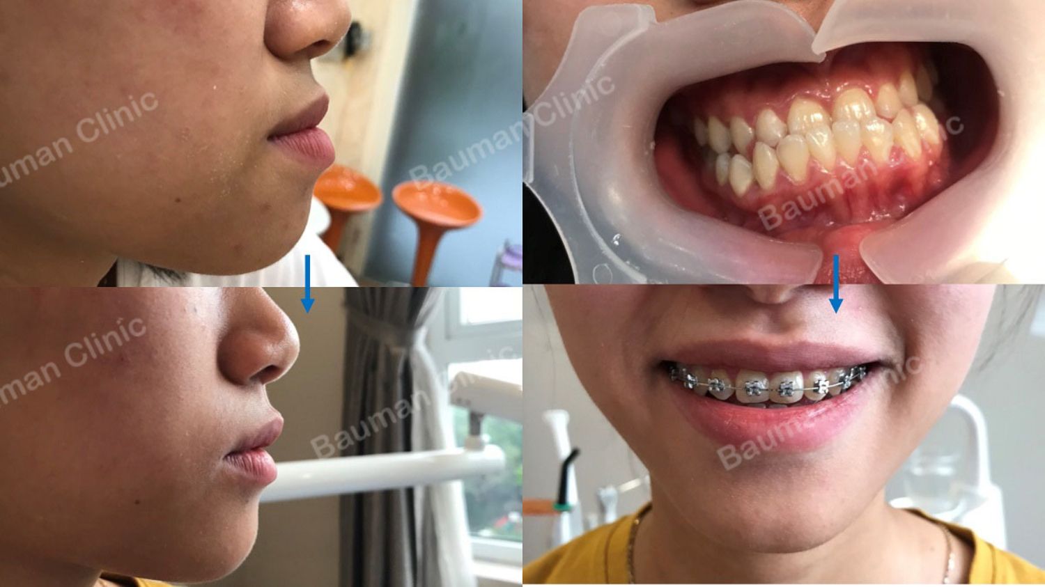 Ca niềng răng số 5082 - Nha khoa Bauman Clinic