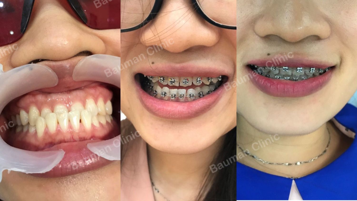 Ca niềng răng số 5083 - Nha khoa Bauman Clinic