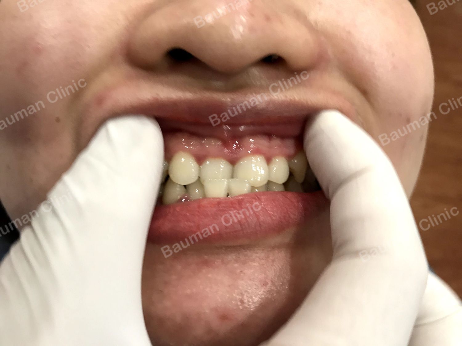 Ca niềng răng số 5015 - Nha khoa Bauman Clinic