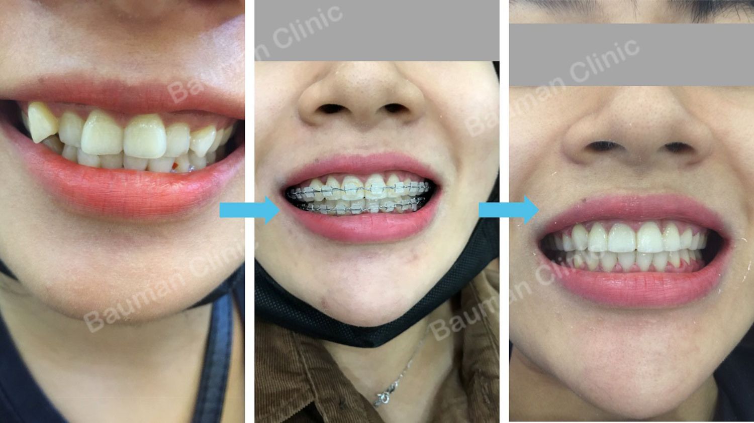 Ca niềng răng số 5046 - Nha khoa Bauman Clinic