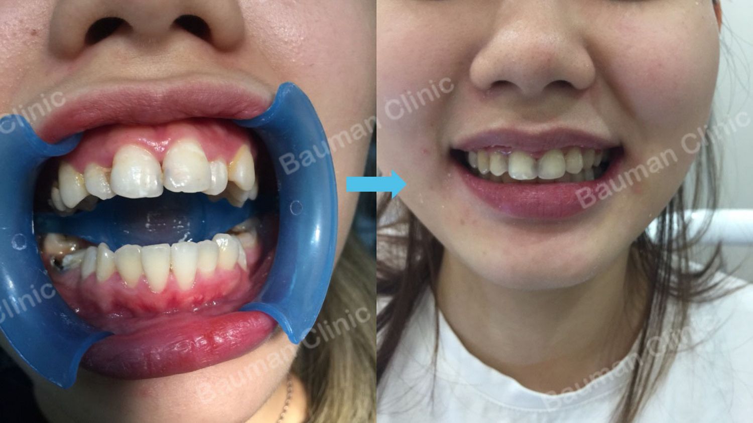 Ca niềng răng số 5050 - Nha khoa Bauman Clinic