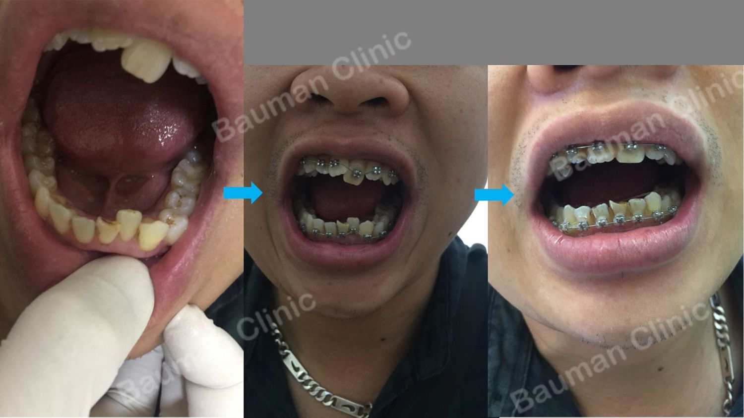 Ca niềng răng số 5042 - Nha khoa Bauman Clinic