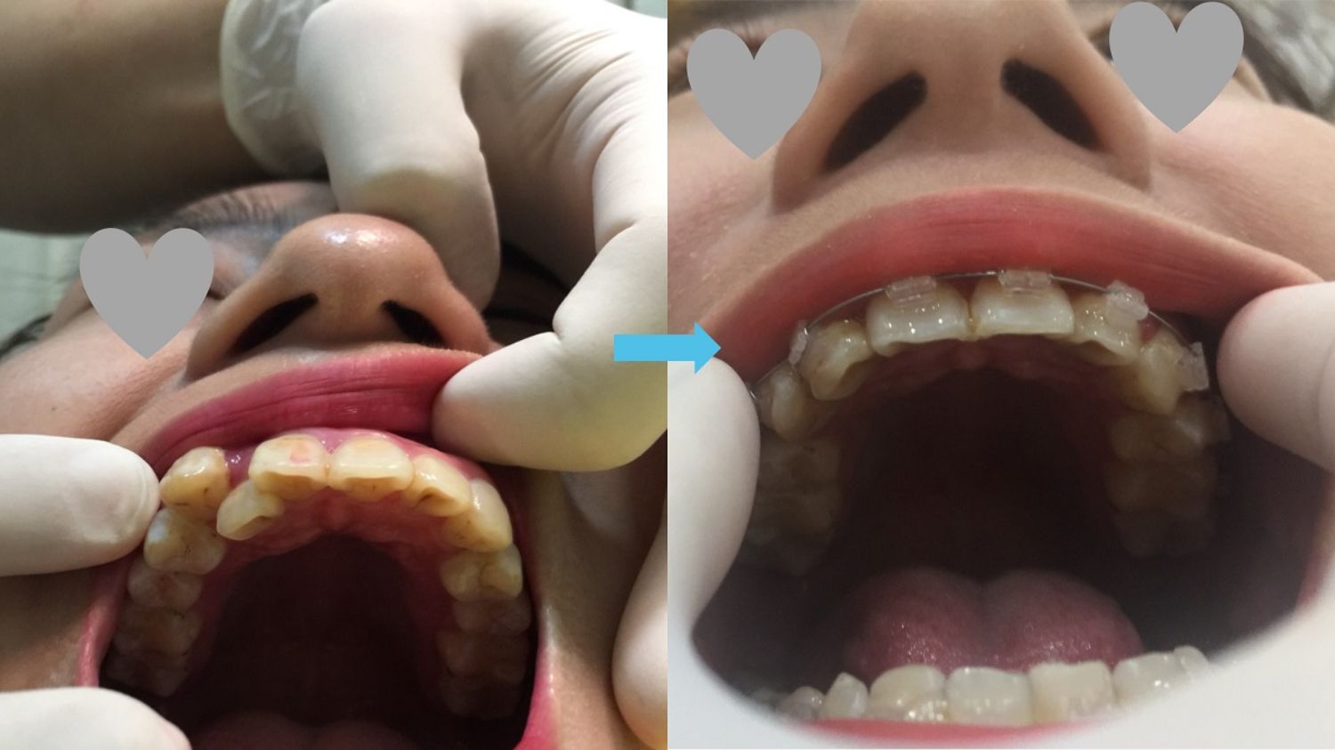 Ca niềng răng số 5053 - Nha khoa Bauman Clinic