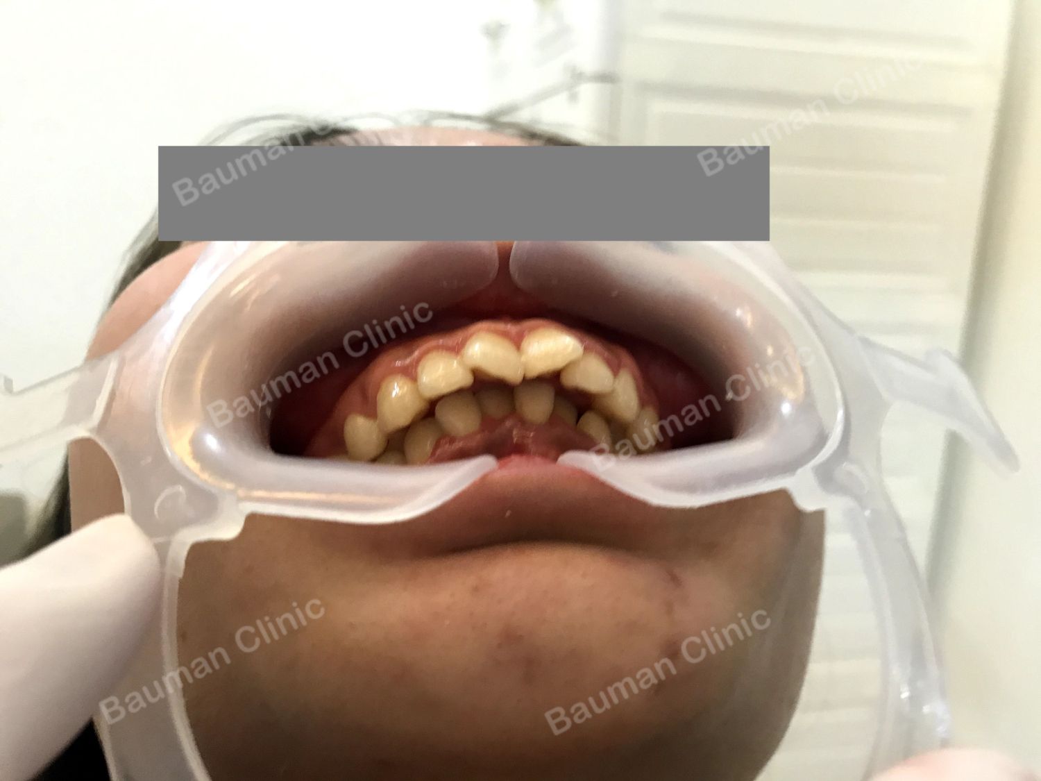 Ca niềng răng số 5011 - Nha khoa Bauman Clinic