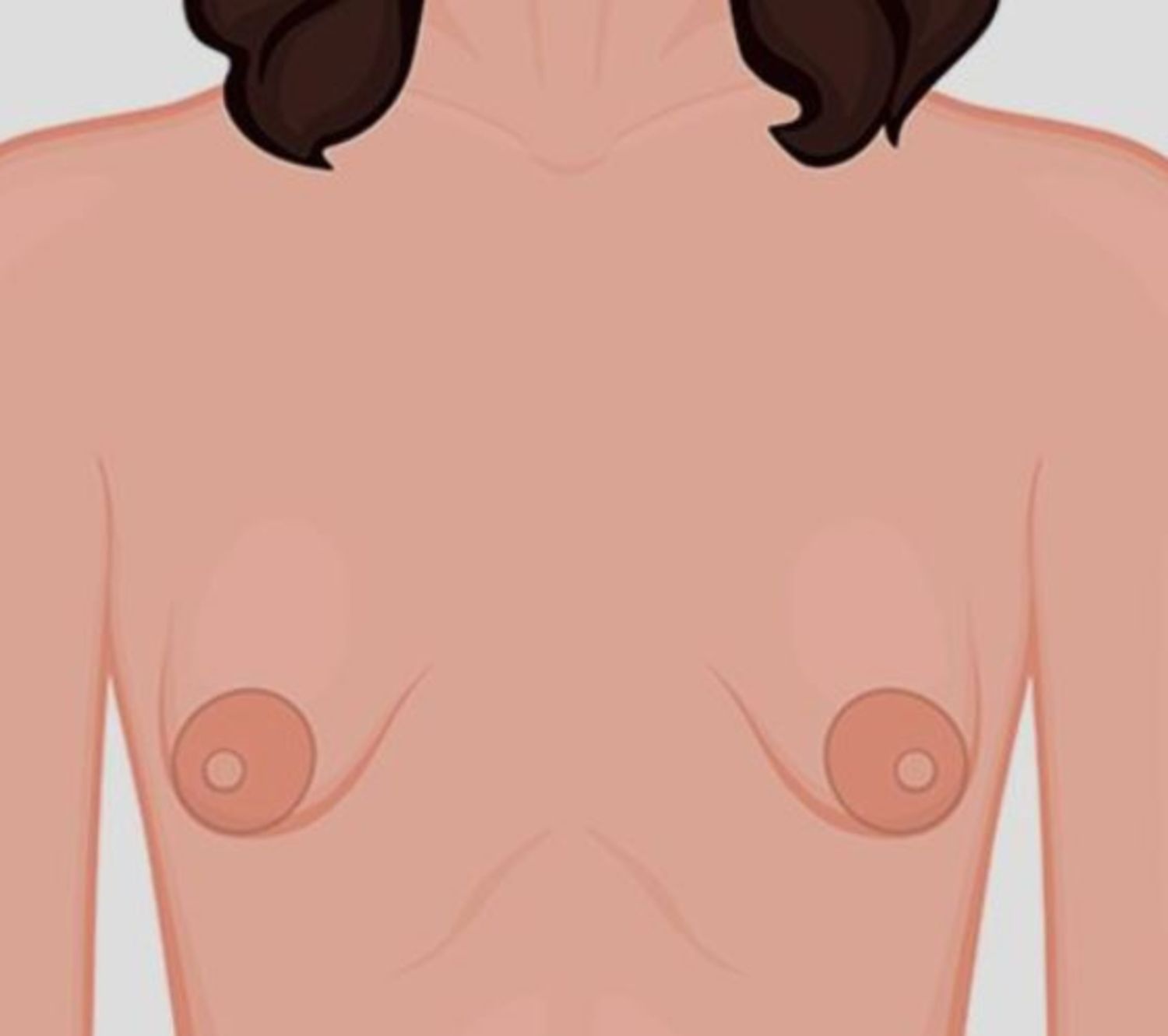 Nâng ngực ở bệnh nhân vú hình ống, ngực lệch - Thẩm mỹ Bauman Clinic