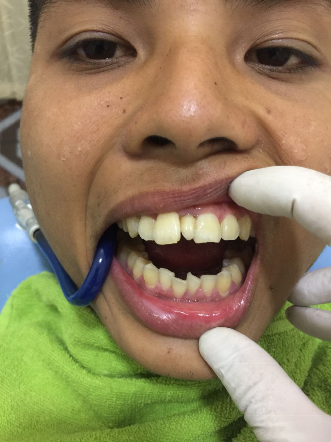 Ca niềng răng số 5045 - Nha khoa Bauman Clinic