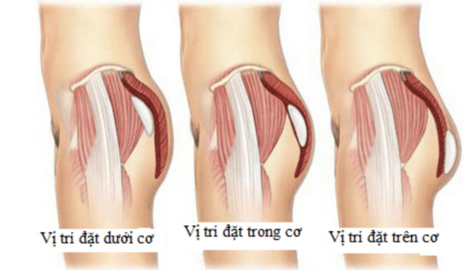 Các vị trí đặt túi độn mông