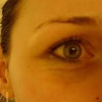 Tiêm botox điều trị các nếp nhăn dưới mắt có an toàn và hiệu quả không?