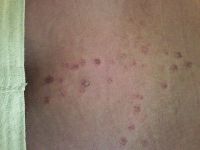 Vết bỏng da sau triệt lông bằng laser có vĩnh viễn không ?