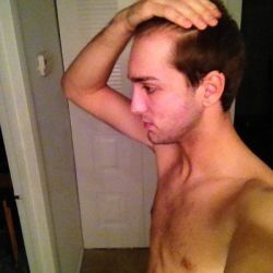 Phân biệt hói đầu và trán rộng (trán cao)