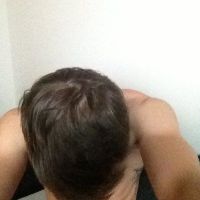 Phân biệt hói đầu và trán rộng (trán cao)