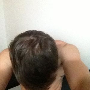 Phân biệt hói đầu và trán rộng (trán cao)