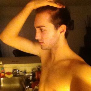 Phân biệt hói đầu và trán rộng (trán cao)