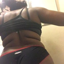 Lưng dày nhiều cuộn mỡ và hút mỡ Smartlipo