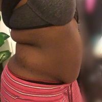 Lưng dày nhiều cuộn mỡ và hút mỡ Smartlipo Lưng dày nhiều cuộn mỡ và hút mỡ Smartlipo