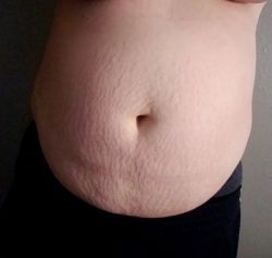 Hút mỡ bằng laser loại bỏ mỡ sau sinh con