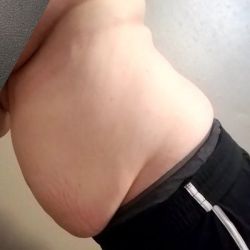 Hút mỡ bằng laser loại bỏ mỡ sau sinh con