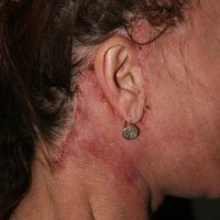 Cách khắc phục mất tóc sau phẫu thuật căng da mặt?