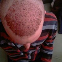 Các nang tóc bị kéo bật lên sau 1 tuần phẫu thuật cấy tóc?