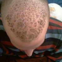 Các nang tóc bị kéo bật lên sau 1 tuần phẫu thuật cấy tóc?