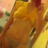 Có thể làm săn chắc da bụng chảy xệ sau giảm cân mà không cần phẫu thuật không?