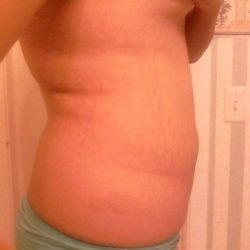 18 tuổi, cao 1m76, nặng 90kg, có nên hút mỡ bằng siêu âm VASER không?