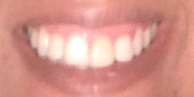 4 răng cửa rất to, dài và rộng có phù hợp với mặt dán sứ Lumineer không?