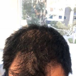 Tôi nên cấy tóc ngay bây giờ hay nên đợi?