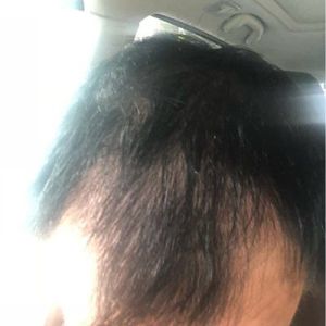 Tôi nên cấy tóc ngay bây giờ hay nên đợi?