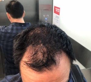 Tôi nên cấy tóc ngay bây giờ hay nên đợi?