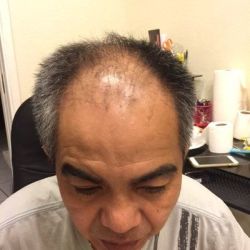 Có nên cấy tóc ở tuổi thanh niên không?