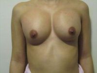 Chỉnh sửa túi độn bị cao ở trên ngực Chỉnh sửa túi độn bị cao ở trên ngực