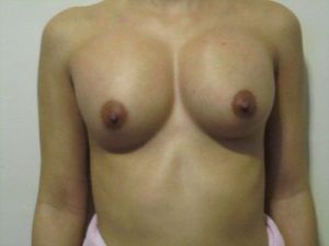 Chỉnh sửa túi độn bị cao ở trên ngực