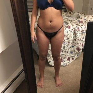 Hút mỡ bằng sóng siêu âm Vaser và cấy mỡ tự thân vào mông