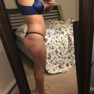 Hút mỡ bằng sóng siêu âm Vaser và cấy mỡ tự thân vào mông