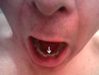 Dán Bonding có thể khắc phục răng cửa hàm dưới bị mẻ không?