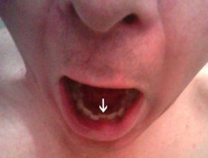 Dán Bonding có thể khắc phục răng cửa hàm dưới bị mẻ không?