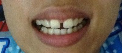 Có thể dán Bonding cho răng cửa mà không khiến cho răng bị mất cân đối không?