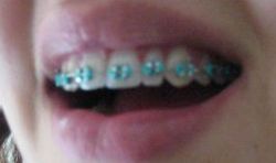 Dán răng Bonding hay dán sứ Lumineer sau khi tháo niềng răng?