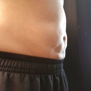 Có thể khắc phục vòng bụng của tôi bằng hút mỡ thông thường hay hút mỡ VASER hay kỹ thuật ab etching?