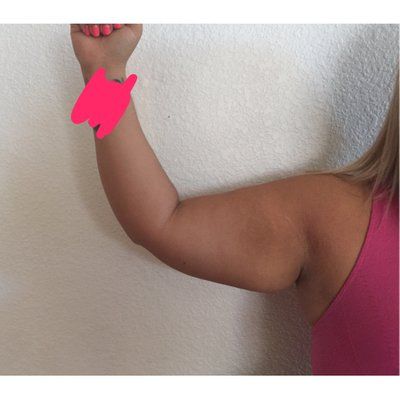 VASER hay Smartlipo hút mỡ cho vùng cánh tay- cái nào tốt hơn?
